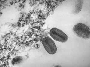 poxvirus - molluscum contagiosum poxvirus - molluscum contagiosum